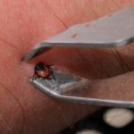 Cum scoţi corect o căpuşă de sub piele şi care sunt primele semne că ar trebui să mergi la medic