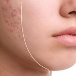 Acid Azelaic: Ghid Complet pentru Integrarea Corectă în Rutină