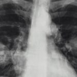 Grijă Pulmonară Integrală: Importanța Hărții Clinicilor de Pneumologie din România