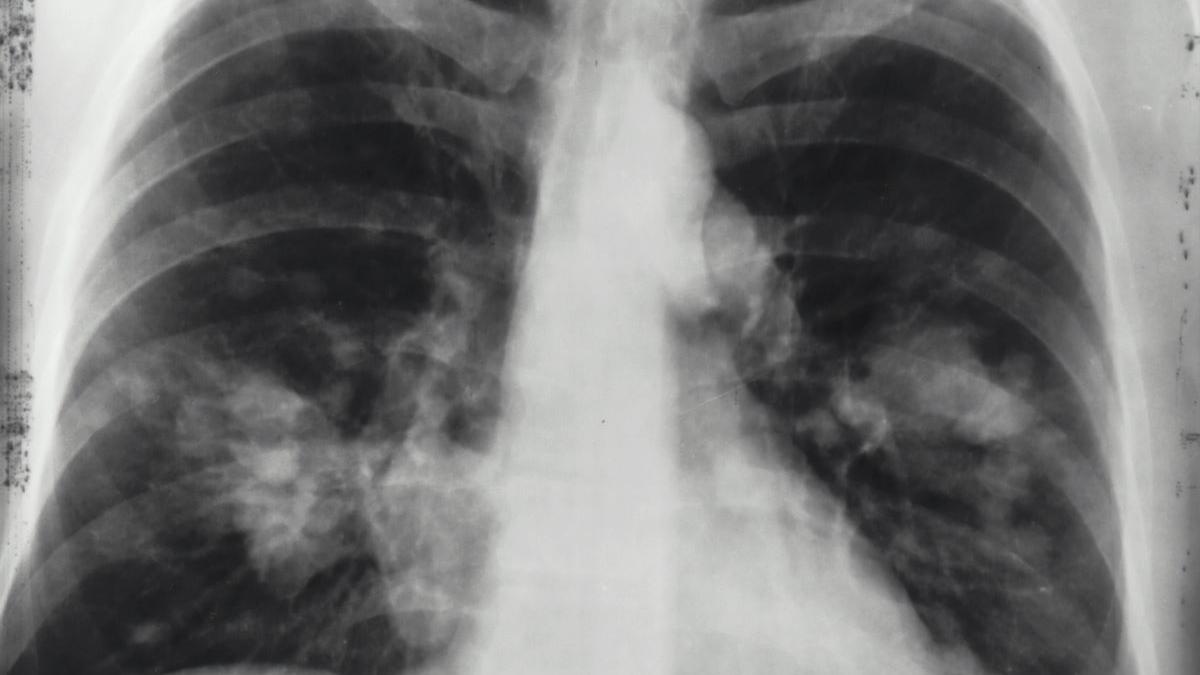 Grijă Pulmonară Integrală: Importanța Hărții Clinicilor de Pneumologie din România