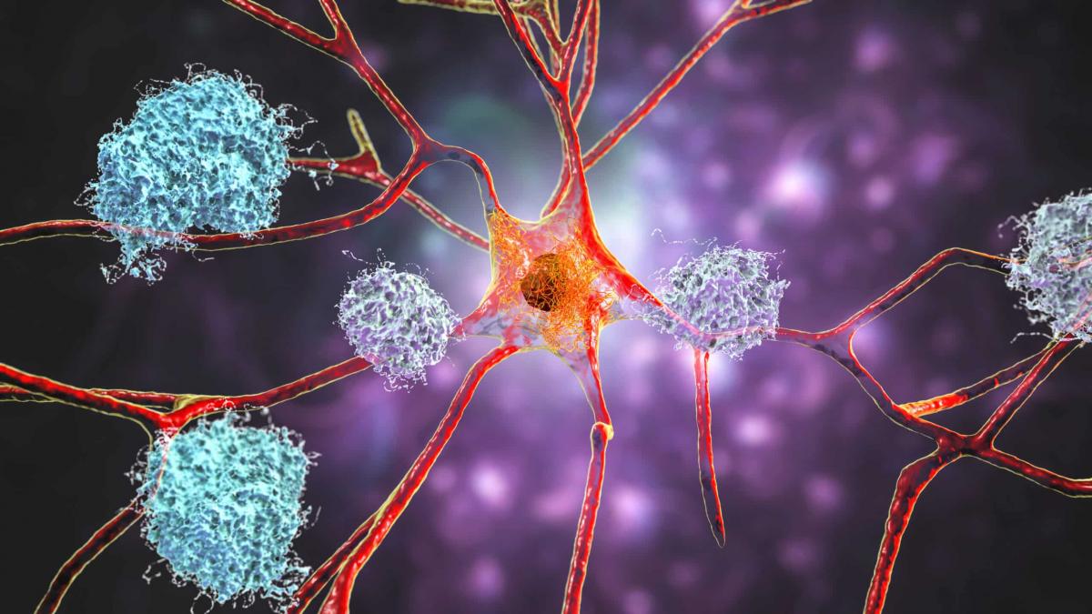 Descoperirea Revoluționară în Medicină: O Perspectivă Asupra Legăturii Între Cancer și Alzheimer
