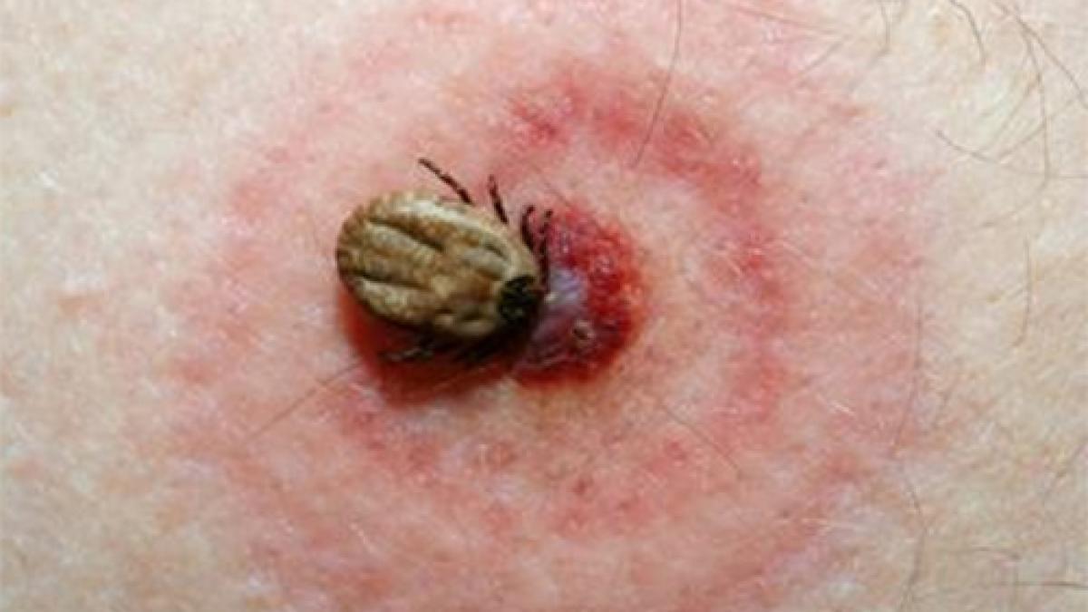 Alergia provocată de mușcăturile de căpușe: O amenințare tot mai gravă pentru sănătatea publică